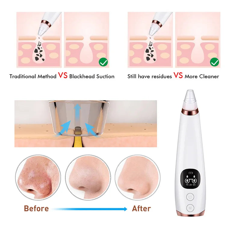 Electric Blackhead and Acne Remover – Black Spot Elimination, Deep Pore Cleansing, Skin Care Machine.